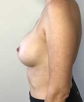 Breast Augmentation Silicone Implants Before and After | CIARAVINO Plastic Surgery