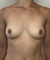 Breast Augmentation Silicone Implants Before and After | CIARAVINO Plastic Surgery