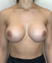 Breast Augmentation Silicone Implants Before and After | CIARAVINO Plastic Surgery