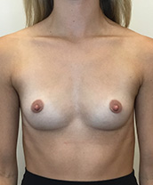 Breast Augmentation Silicone Implants Before and After | CIARAVINO Plastic Surgery