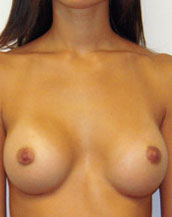 Breast Augmentation Silicone Implants Before and After | CIARAVINO Plastic Surgery