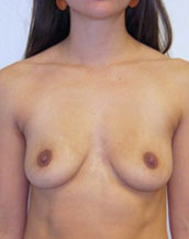 Breast Augmentation Silicone Implants Before and After | CIARAVINO Plastic Surgery