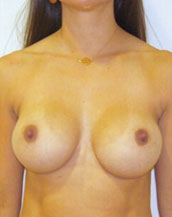 Breast Augmentation Silicone Implants Before and After | CIARAVINO Plastic Surgery