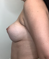 Breast Augmentation Silicone Implants Before and After | CIARAVINO Plastic Surgery