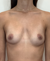 Breast Augmentation Silicone Implants Before and After | CIARAVINO Plastic Surgery