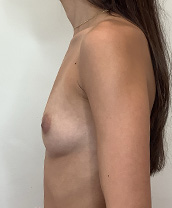 Breast Augmentation Silicone Implants Before and After | CIARAVINO Plastic Surgery