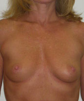 Breast Augmentation Silicone Implants Before and After | CIARAVINO Plastic Surgery