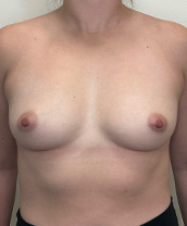 Breast Augmentation Silicone Implants Before and After | CIARAVINO Plastic Surgery