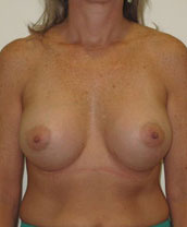 Breast Augmentation Silicone Implants Before and After | CIARAVINO Plastic Surgery