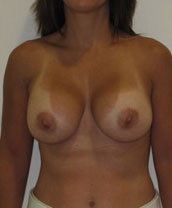 Breast Augmentation Silicone Implants Before and After | CIARAVINO Plastic Surgery