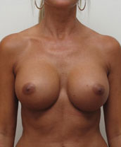 Breast Augmentation Silicone Implants Before and After | CIARAVINO Plastic Surgery