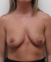 Breast Augmentation Silicone Implants Before and After | CIARAVINO Plastic Surgery