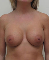 Breast Augmentation Silicone Implants Before and After | CIARAVINO Plastic Surgery