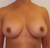 Breast Augmentation Silicone Implants Before and After | CIARAVINO Plastic Surgery