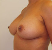 Breast Augmentation Silicone Implants Before and After | CIARAVINO Plastic Surgery