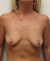 Breast Augmentation Silicone Implants Before and After | CIARAVINO Plastic Surgery