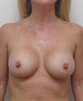 Breast Augmentation Silicone Implants Before and After | CIARAVINO Plastic Surgery