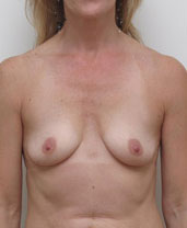 Breast Augmentation Silicone Implants Before and After | CIARAVINO Plastic Surgery