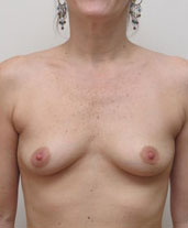 Breast Augmentation Silicone Implants Before and After | CIARAVINO Plastic Surgery