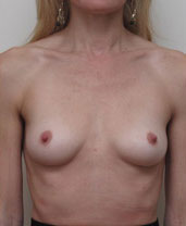 Breast Augmentation Silicone Implants Before and After | CIARAVINO Plastic Surgery