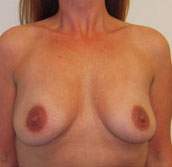 Breast Augmentation Silicone Implants Before and After | CIARAVINO Plastic Surgery