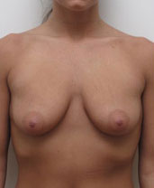 Breast Augmentation Silicone Implants Before and After | CIARAVINO Plastic Surgery