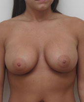 Breast Augmentation Silicone Implants Before and After | CIARAVINO Plastic Surgery