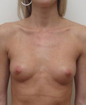 Breast Augmentation Silicone Implants Before and After | CIARAVINO Plastic Surgery