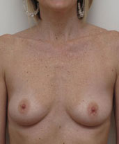 Breast Augmentation Silicone Implants Before and After | CIARAVINO Plastic Surgery