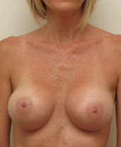 Breast Augmentation Silicone Implants Before and After | CIARAVINO Plastic Surgery