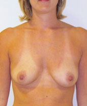 Breast Augmentation Silicone Implants Before and After | CIARAVINO Plastic Surgery