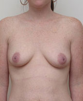 Breast Augmentation Silicone Implants Before and After | CIARAVINO Plastic Surgery