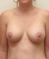 Breast Augmentation Silicone Implants Before and After | CIARAVINO Plastic Surgery