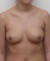 Breast Augmentation Silicone Implants Before and After | CIARAVINO Plastic Surgery