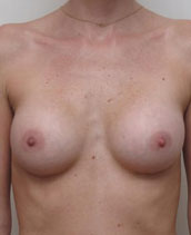 Breast Augmentation Silicone Implants Before and After | CIARAVINO Plastic Surgery