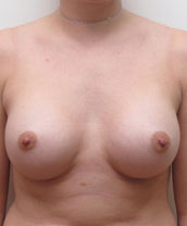 Breast Augmentation Silicone Implants Before and After | CIARAVINO Plastic Surgery