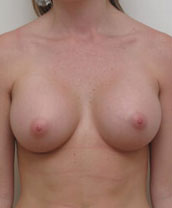 Breast Augmentation Silicone Implants Before and After | CIARAVINO Plastic Surgery