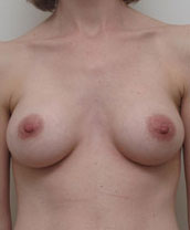 Breast Augmentation Silicone Implants Before and After | CIARAVINO Plastic Surgery