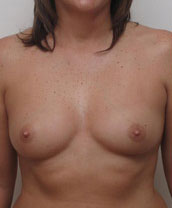 Breast Augmentation Silicone Implants Before and After | CIARAVINO Plastic Surgery