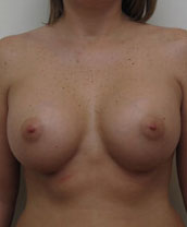 Breast Augmentation Silicone Implants Before and After | CIARAVINO Plastic Surgery