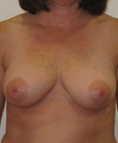 Breast Augmentation Silicone Implants Before and After | CIARAVINO Plastic Surgery