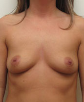 Breast Augmentation Silicone Implants Before and After | CIARAVINO Plastic Surgery