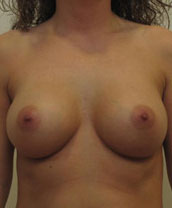 Breast Augmentation Silicone Implants Before and After | CIARAVINO Plastic Surgery