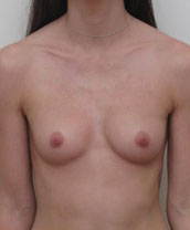 Breast Augmentation Silicone Implants Before and After | CIARAVINO Plastic Surgery