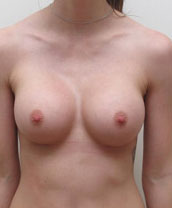 Breast Augmentation Silicone Implants Before and After | CIARAVINO Plastic Surgery