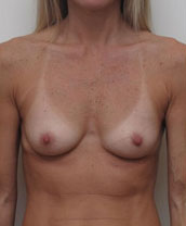 Breast Augmentation Silicone Implants Before and After | CIARAVINO Plastic Surgery