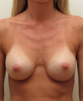 Breast Augmentation Silicone Implants Before and After | CIARAVINO Plastic Surgery