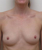 Breast Augmentation Silicone Implants Before and After | CIARAVINO Plastic Surgery