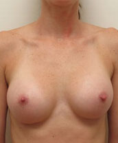 Breast Augmentation Silicone Implants Before and After | CIARAVINO Plastic Surgery