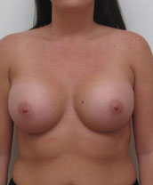 Breast Augmentation Silicone Implants Before and After | CIARAVINO Plastic Surgery